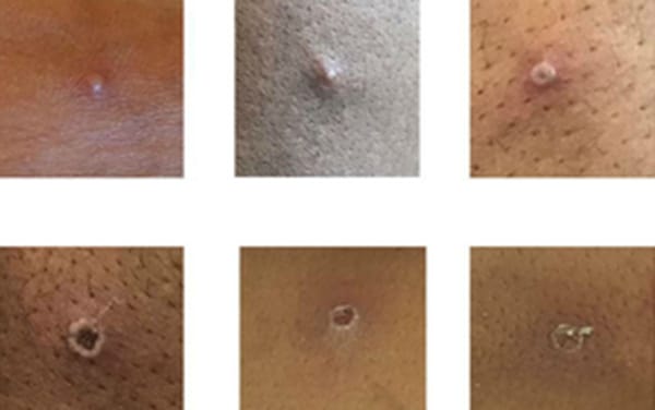 Monkeypox: UK confirms four new cases among gay and bisexual men