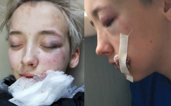 Russian girl hospitalised after horrific homophobic attack from seven men