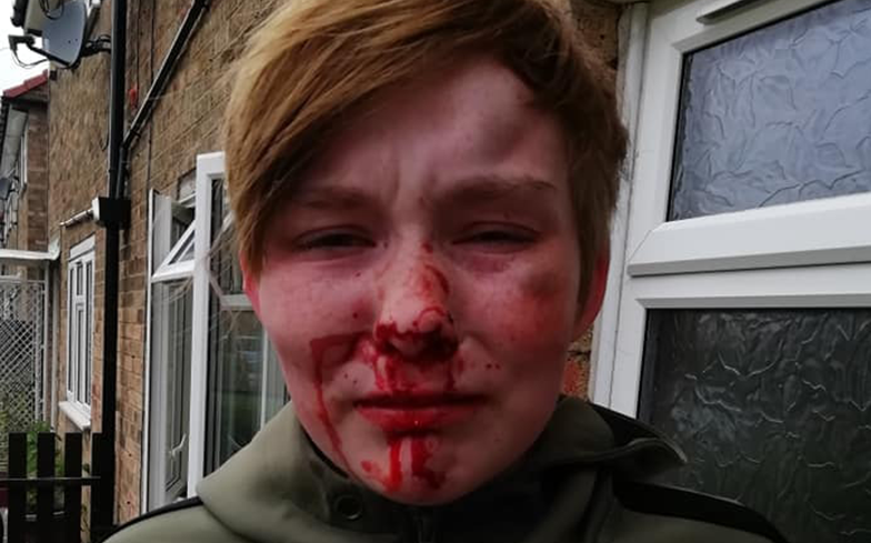 Teen viciously beaten and called a “f***ing lesbian” over £10