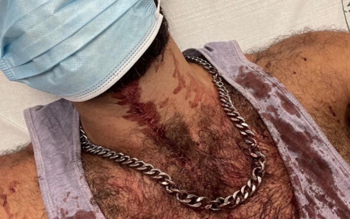 Gay man’s jaw shattered with hammer in suspected homophobic attack